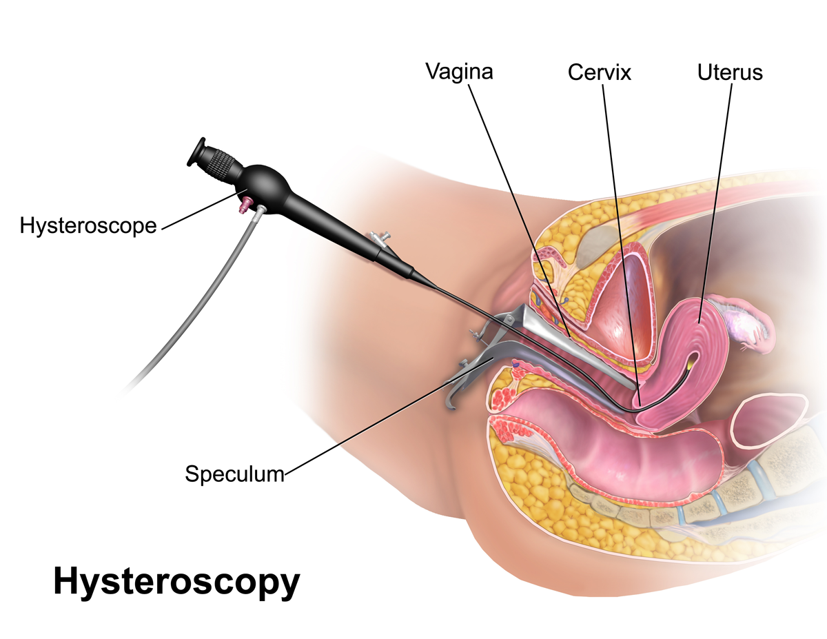 Advance Gynecology Center - Hysteroscopy step-by-step process