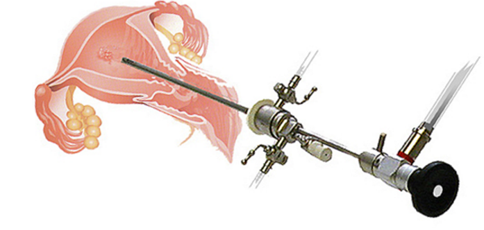 Office Hysteroscopy - Advance Gynecology Center, Hyderabad