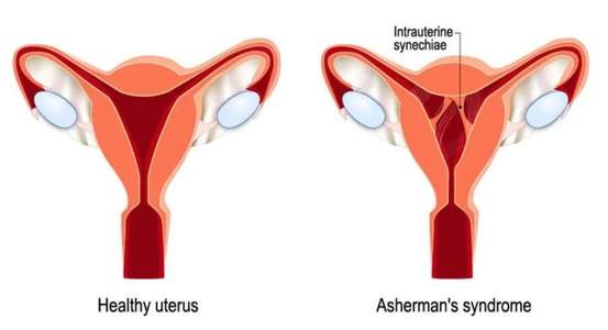 Advance Gynecology Center - Asherman’s Syndrome