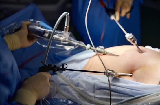 Advance Gynecology Center - Benefits Of Laparoscopy