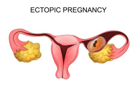 Ectopic Pregnancy