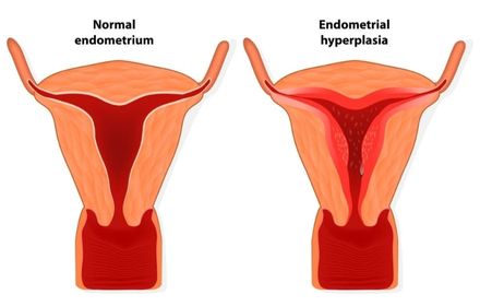 Advance Gynecology Center Endometrial Hyperplasia