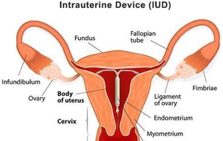 Foreign Body IUD Localization & Removal