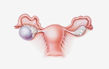 Ovarian Cysts Masses