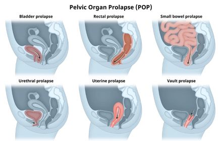 Pelvic Organ Prolapse