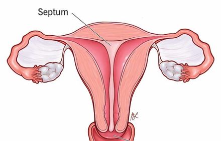 Uterine Septum