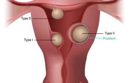 Uterine Septum