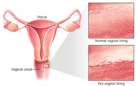 Vaginal Atrophy