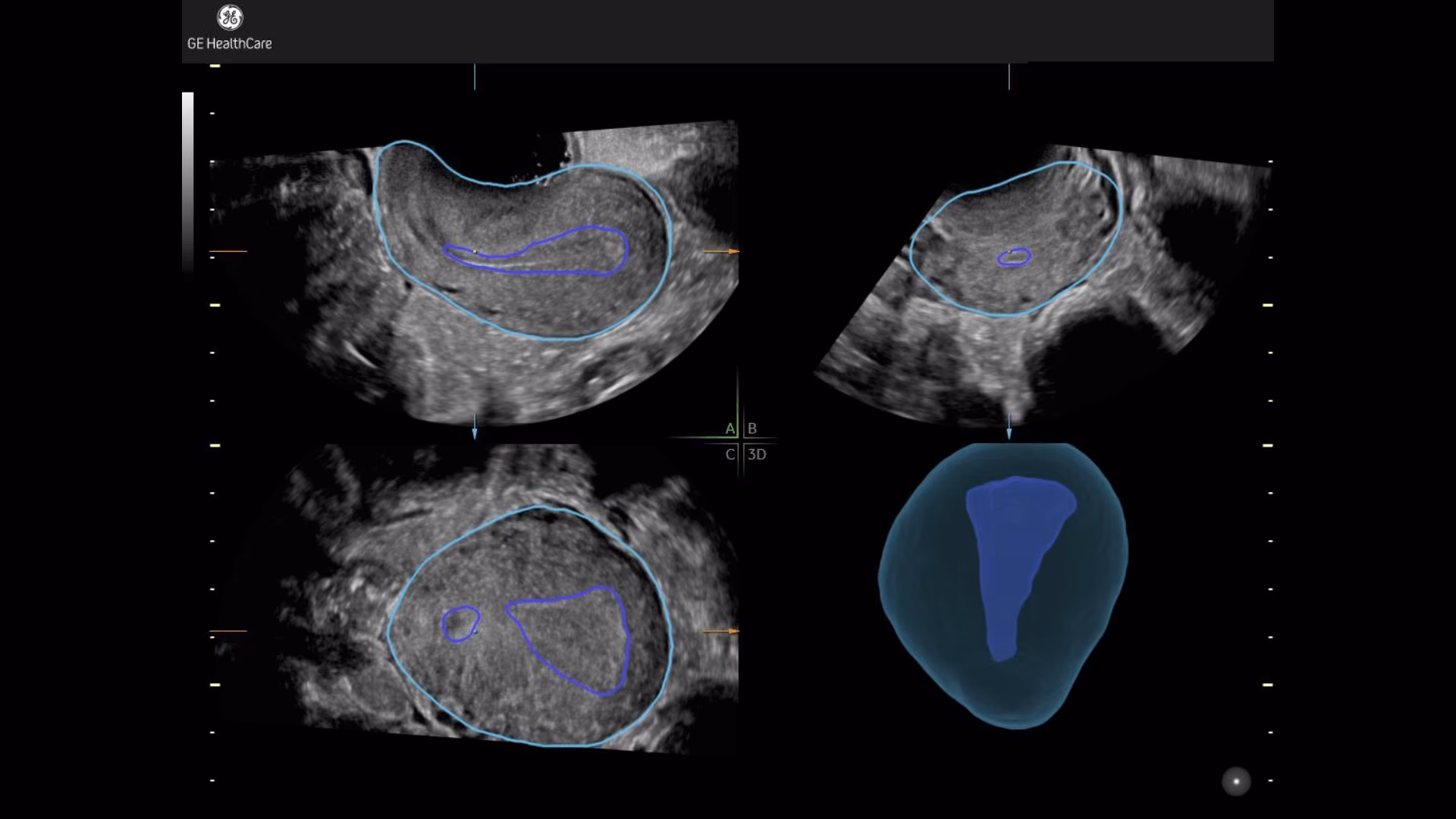 1-fibroid-mapping-tool
