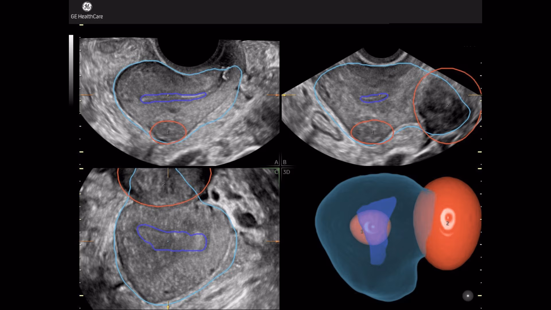 3_fibroid-mapping-ultrahd