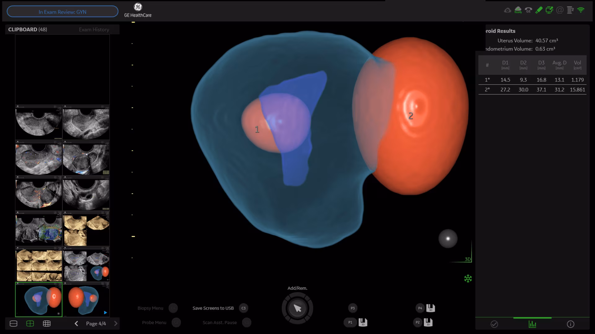 4_fibroid-mapping-clinical_image
