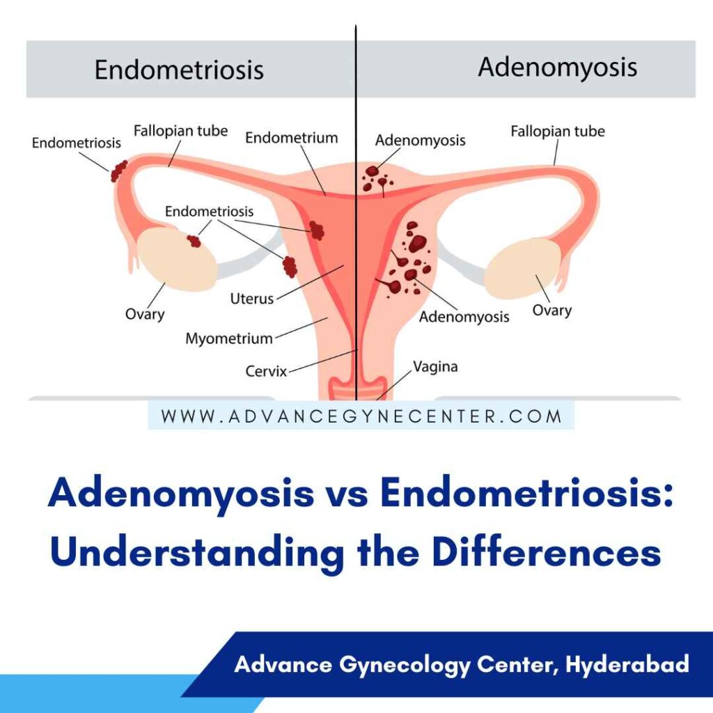 Adenomyosis vs Endometriosis Understanding the Differences