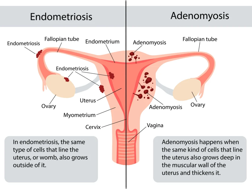 endometriosis-vs-adenomyosis