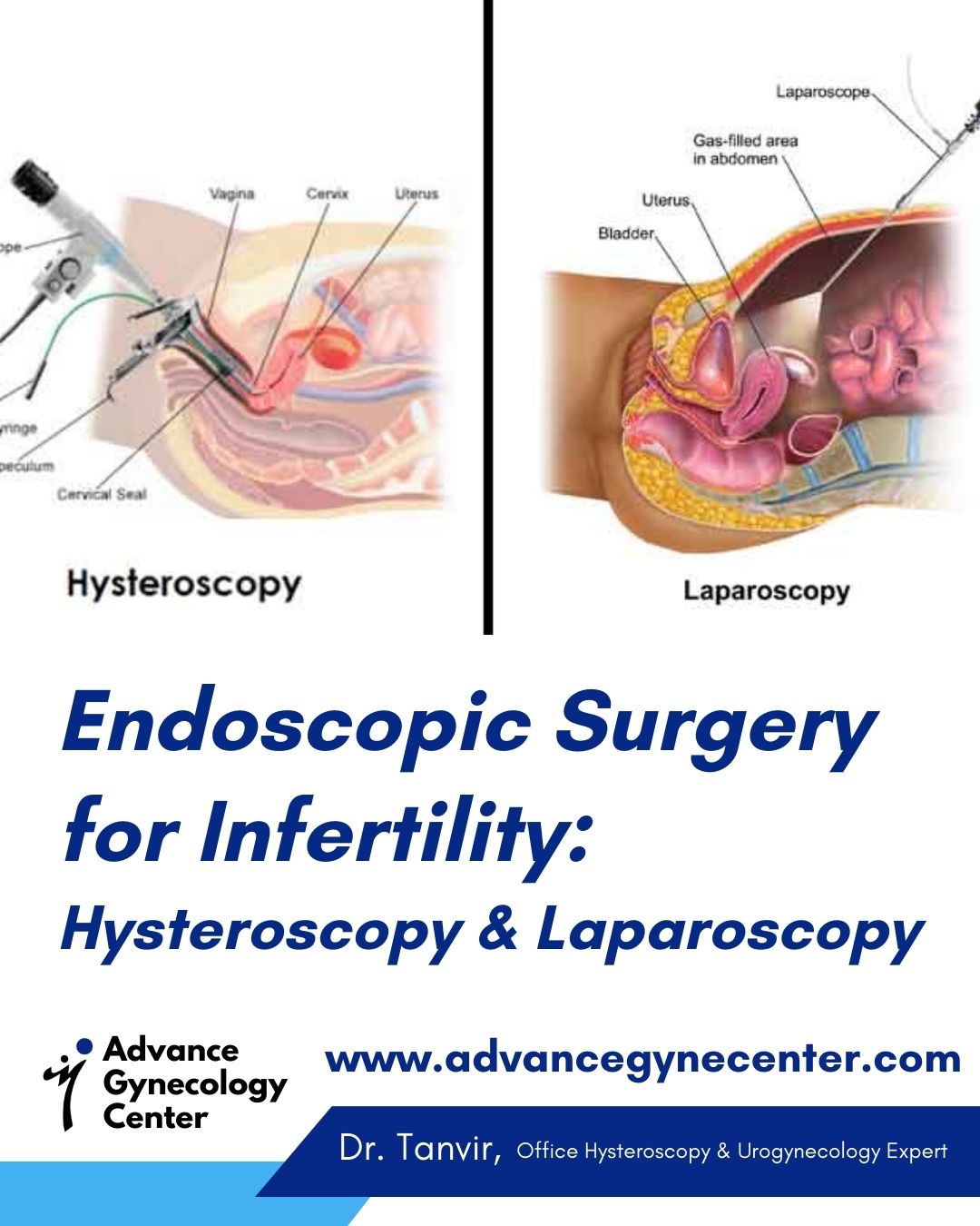 Endoscopic Surgery for Infertility: Hysteroscopy & Laparoscopy