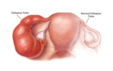 Hydrosalpinx treatment in Hyderabad