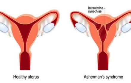 Advance Gynecology Center - Asherman’s Syndrome